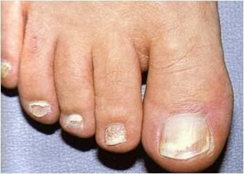 El hongo de la uña del pulgar en los pies